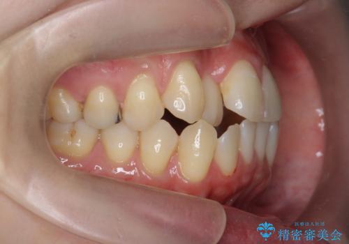 引っ込んだ前歯を並べたい マウスピースと部分ワイヤーのコンビネーション矯正の治療前