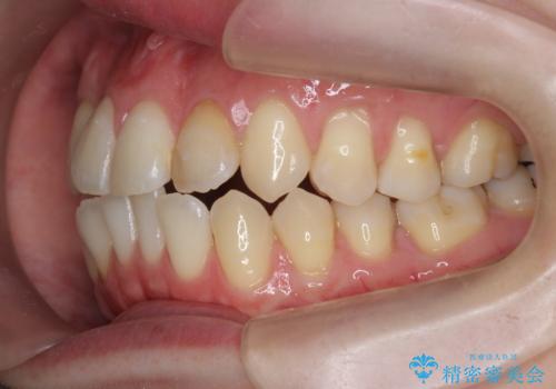引っ込んだ前歯を並べたい マウスピースと部分ワイヤーのコンビネーション矯正の治療前