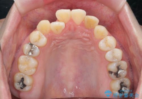 引っ込んだ前歯を並べたい　マウスピースと部分ワイヤーのコンビネーション矯正の治療前