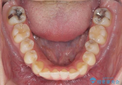 引っ込んだ前歯を並べたい マウスピースと部分ワイヤーのコンビネーション矯正の治療前