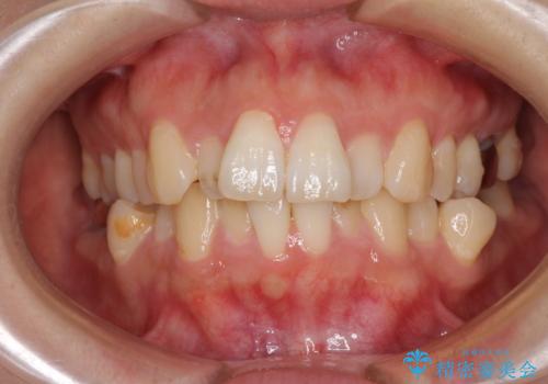 目立たない裏側装置でデコボコをきれいに解消の治療前