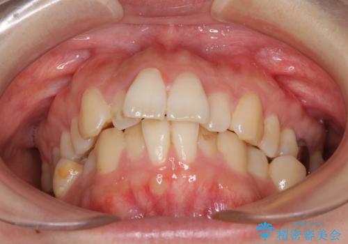 目立たない裏側装置でデコボコをきれいに解消の治療前