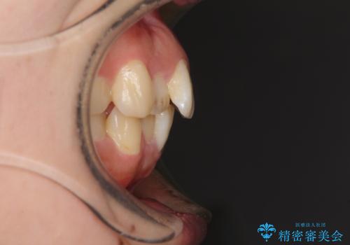 目立たない裏側装置でデコボコをきれいに解消の治療前