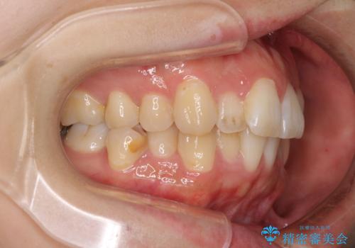 目立たない裏側装置でデコボコをきれいに解消の治療前
