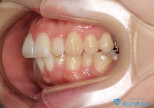 目立たない裏側装置でデコボコをきれいに解消の治療前