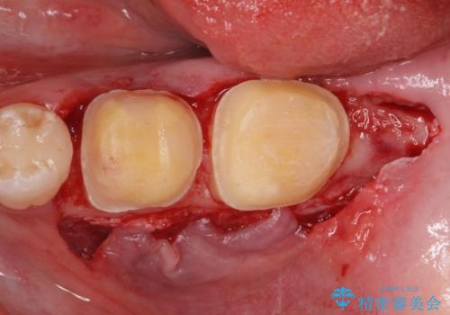 APF(歯肉弁根尖側移動術)の治療中