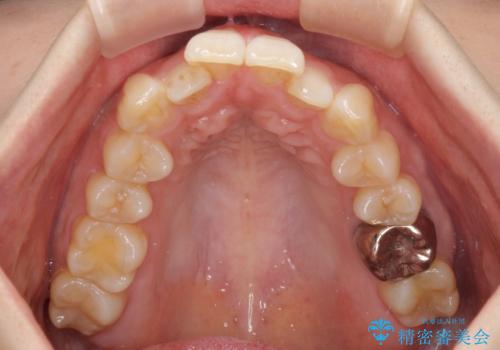 目立たない裏側装置でデコボコをきれいに解消の治療前
