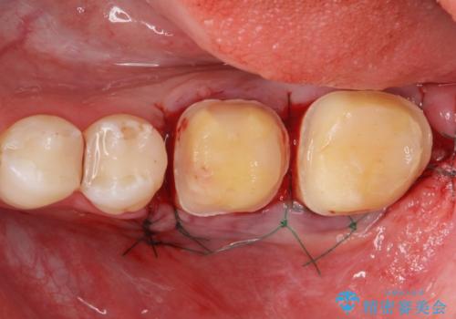 APF(歯肉弁根尖側移動術)の治療中