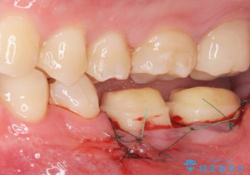 APF(歯肉弁根尖側移動術)の治療中
