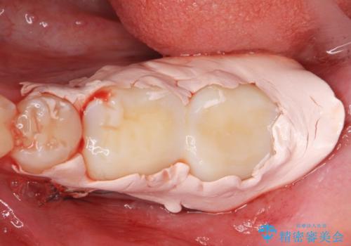 APF(歯肉弁根尖側移動術)の治療後