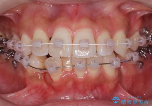犬歯が歯ぐきにうまっている　真ん中のずれ、出っ歯を治したいの治療中