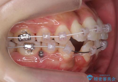 犬歯が歯ぐきにうまっている　真ん中のずれ、出っ歯を治したいの治療中
