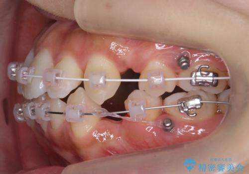 犬歯が歯ぐきにうまっている 真ん中のずれ、出っ歯を治したいの治療中