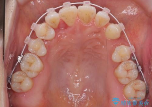 犬歯が歯ぐきにうまっている 真ん中のずれ、出っ歯を治したいの治療中