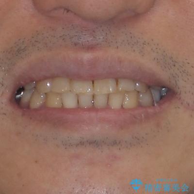 激痛の奥歯のむし歯治療 折角なので矯正治療もしたいの治療後(顔貌)