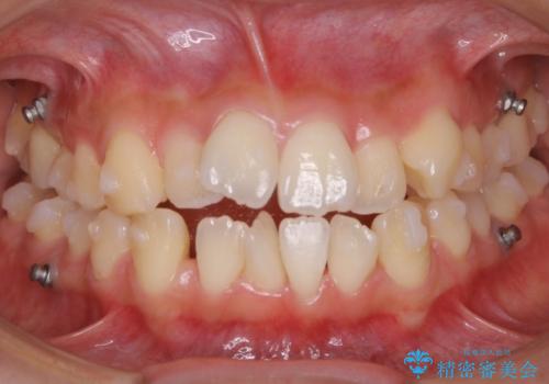 【非抜歯】マイクロインプラントで効率よく矯正を!の治療中