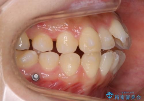 【非抜歯】マイクロインプラントで効率よく矯正を!の治療中