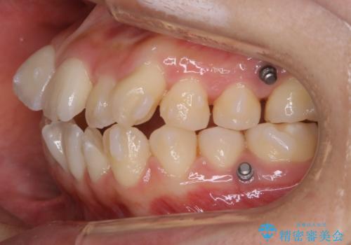 【非抜歯】マイクロインプラントで効率よく矯正を!の治療中