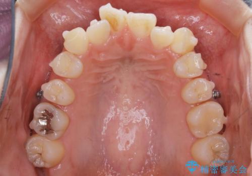 【非抜歯】マイクロインプラントで効率よく矯正を!の治療中