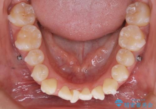 【非抜歯】マイクロインプラントで効率よく矯正を!の治療中