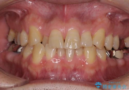 激痛の奥歯のむし歯治療 折角なので矯正治療もしたいの症例 治療前