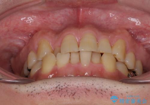 激痛の奥歯のむし歯治療 折角なので矯正治療もしたいの治療前