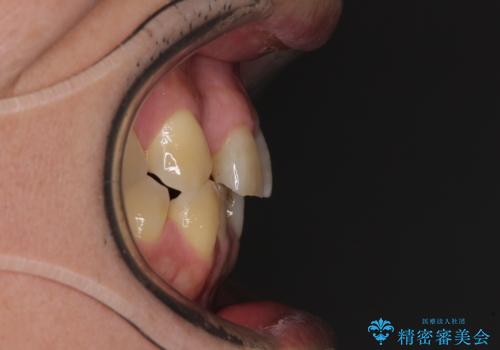 激痛の奥歯のむし歯治療 折角なので矯正治療もしたいの治療前