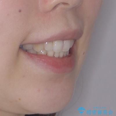 補助装置を用いて奥歯の咬み合わせを事前に改善 インビザラインによる矯正治療の治療後(顔貌)
