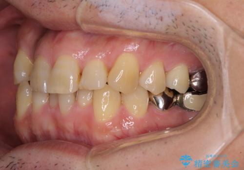 激痛の奥歯のむし歯治療 折角なので矯正治療もしたいの治療前