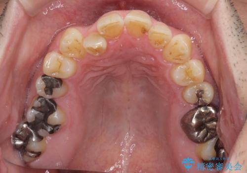 激痛の奥歯のむし歯治療 折角なので矯正治療もしたいの治療前