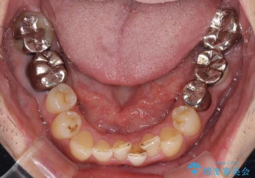 激痛の奥歯のむし歯治療 折角なので矯正治療もしたいの治療前