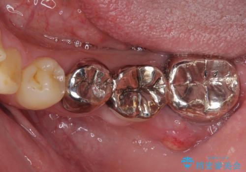 激痛の奥歯のむし歯治療 折角なので矯正治療もしたいの治療前