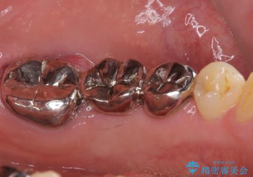 激痛の奥歯のむし歯治療 折角なので矯正治療もしたいの治療前