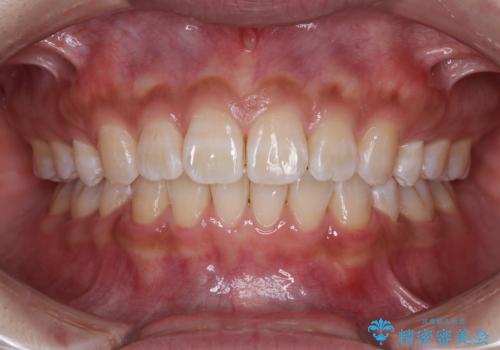 くちばしのような前歯　抜歯矯正で口を閉じやすくの症例 治療後