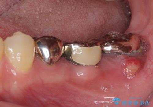 激痛の奥歯のむし歯治療 折角なので矯正治療もしたいの治療前