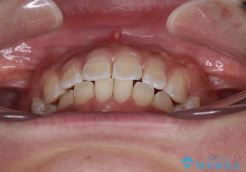 くちばしのような前歯 抜歯矯正で口を閉じやすくの治療後