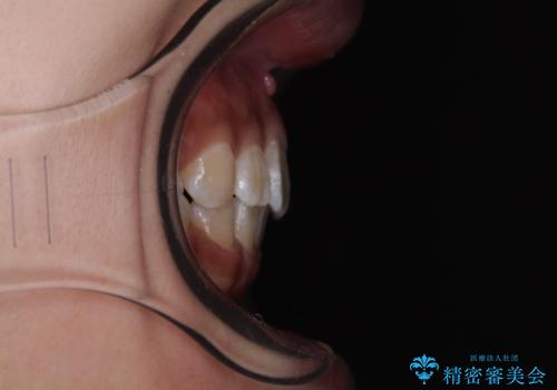 くちばしのような前歯 抜歯矯正で口を閉じやすくの治療後