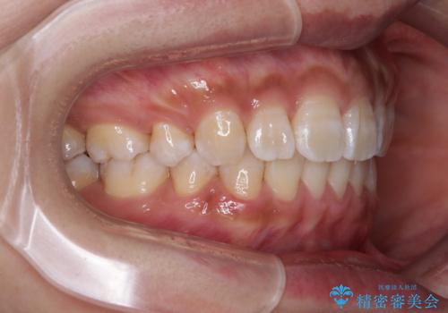 くちばしのような前歯 抜歯矯正で口を閉じやすくの治療後
