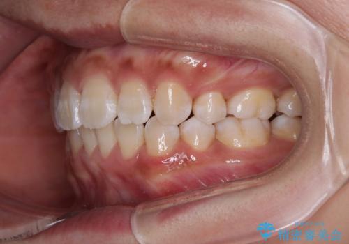 くちばしのような前歯 抜歯矯正で口を閉じやすくの治療後