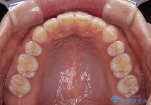 くちばしのような前歯 抜歯矯正で口を閉じやすくの治療後