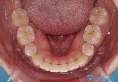 くちばしのような前歯　抜歯矯正で口を閉じやすくの治療後