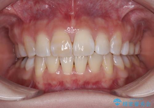 矯正の後戻りと奥歯の欠損 ワイヤー矯正とインプラント治療の症例 治療後