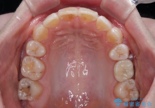 矯正の後戻りと奥歯の欠損 ワイヤー矯正とインプラント治療の治療後