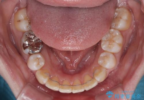 矯正の後戻りと奥歯の欠損 ワイヤー矯正とインプラント治療の治療後