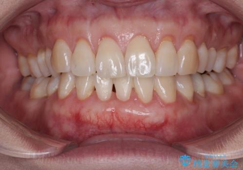 下がってきた歯茎を何とかしたい　歯肉移植による歯肉退縮の改善の症例 治療後