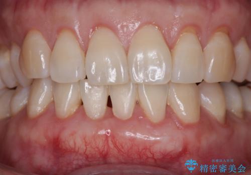 下がってきた歯茎を何とかしたい　歯肉移植による歯肉退縮の改善の治療後