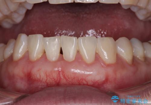 下がってきた歯茎を何とかしたい　歯肉移植による歯肉退縮の改善