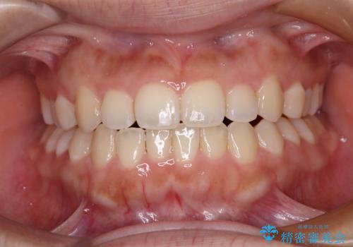 前歯のクロスバイトを改善 インビザライン・モデレートによる矯正治療の治療中