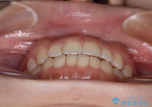 前歯のクロスバイトを改善　インビザライン・モデレートによる矯正治療の治療中