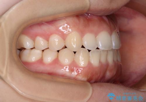 前歯のクロスバイトを改善 インビザライン・モデレートによる矯正治療の治療中